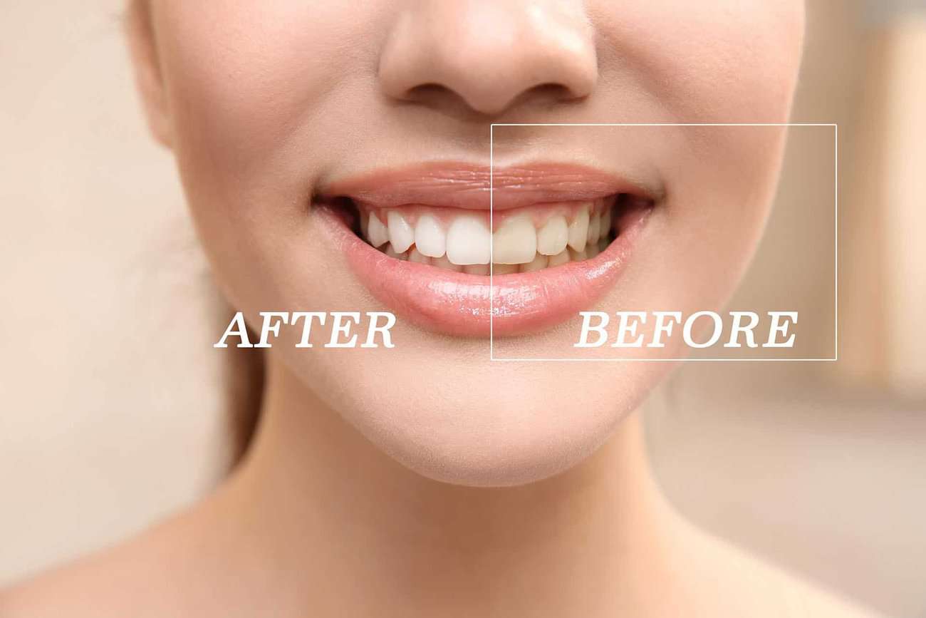 What Are the Most Effective Natural Teeth Whitening Methods You Can Try Barnsley?