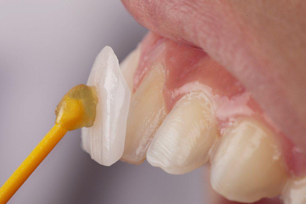Dental Veneers: Achieving a Flawless Look Barnsley