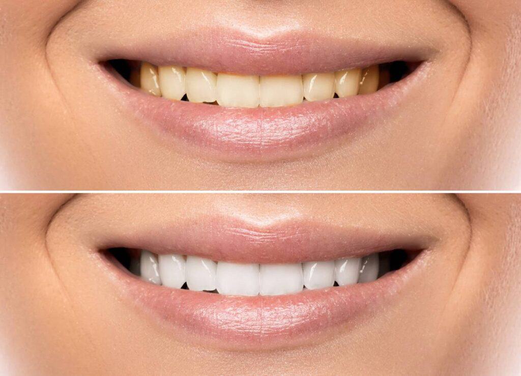 How Does Gum Disease Progress if Left Untreated Barnsley?