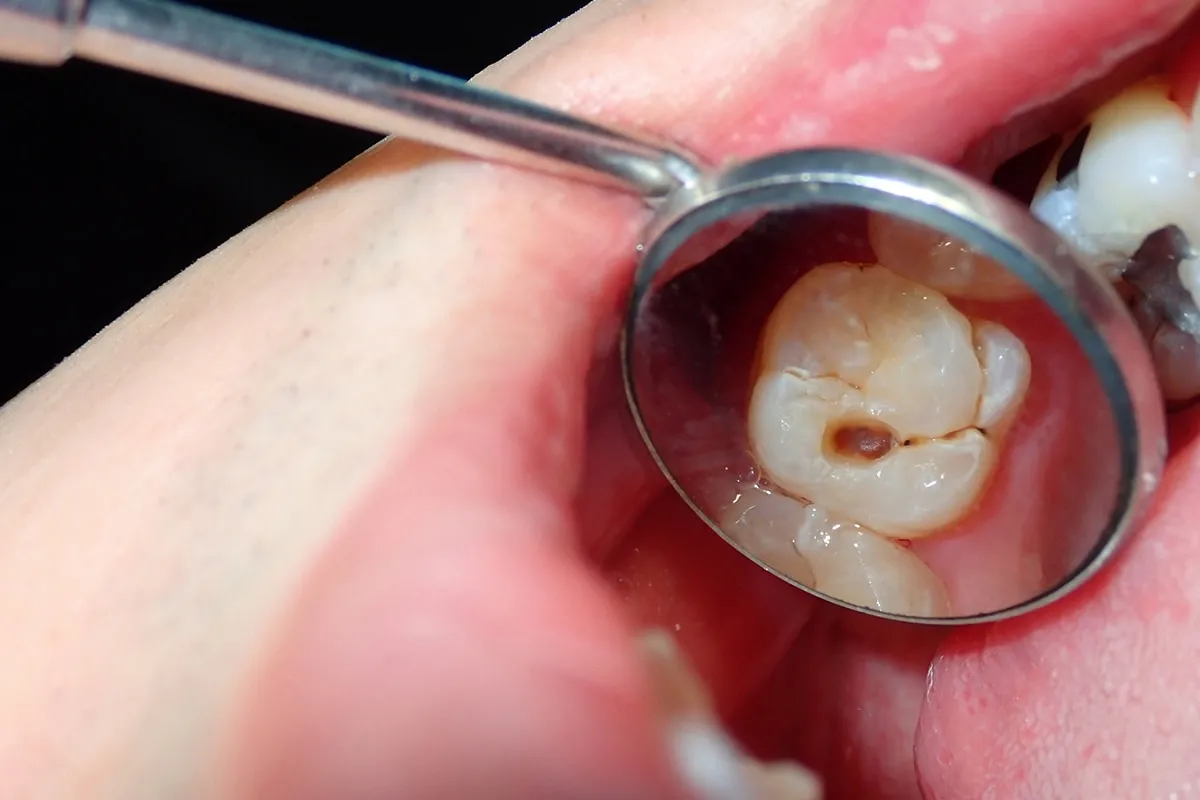 Why Do Teeth Crack? Common Causes to Know Barnsley