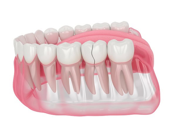 How Can You Manage Pain and Discomfort After a Root Canal Barnsley?