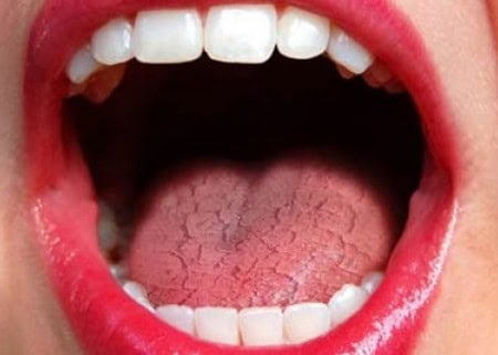 Common Causes of Dry Mouth (Xerostomia) Barnsley