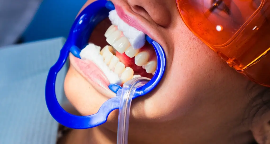 How Teeth Whitening Treatments Actually Work on Your Enamel Barnsley