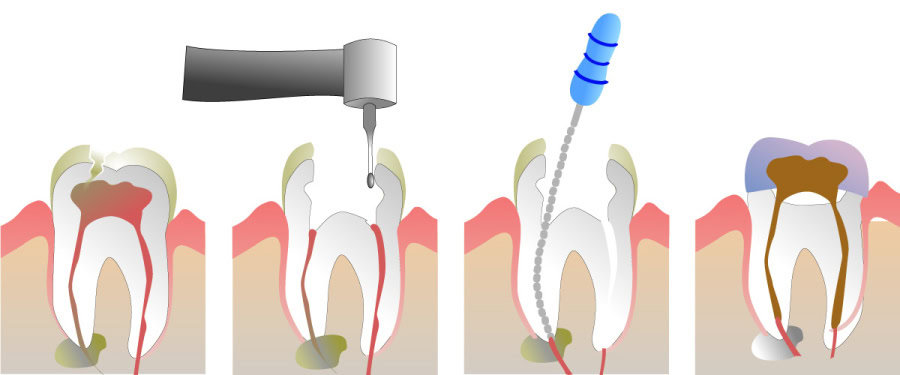How Do You Properly Care for Your Teeth After a Root Canal Barnsley