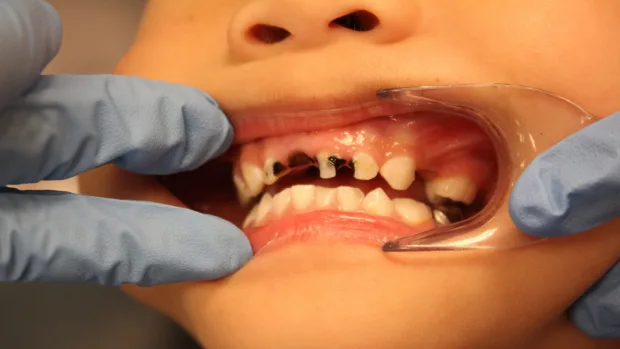 Which Foods and Drinks Cause the Most Damage to Young Smiles Barnsley?