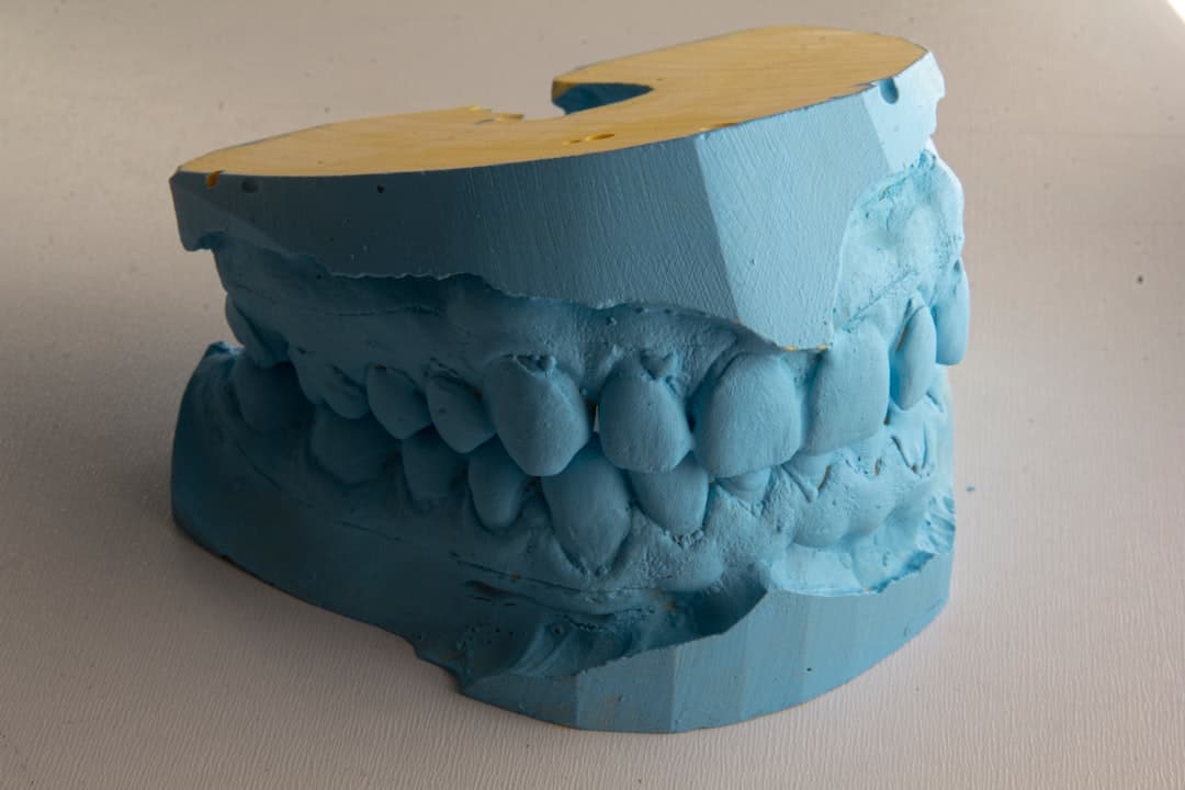 How Do Dental Implants Improve Jawbone Health and Oral Function Barnsley?