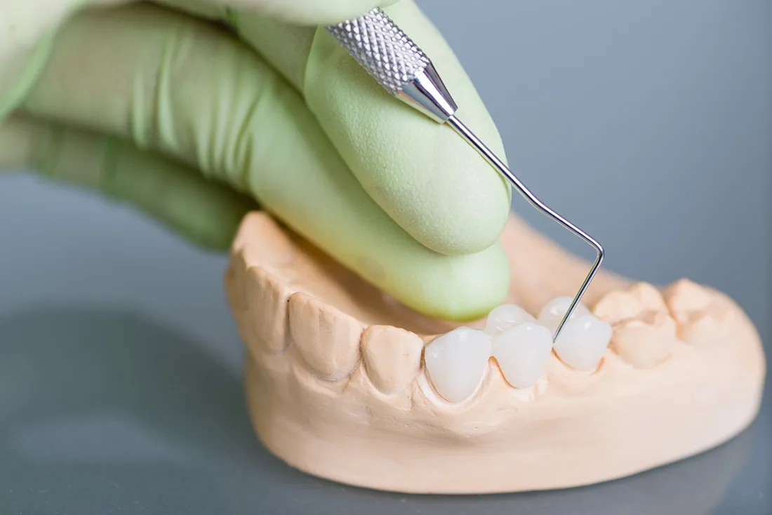 What Are the Different Types of Dental Crowns Available Barnsley?