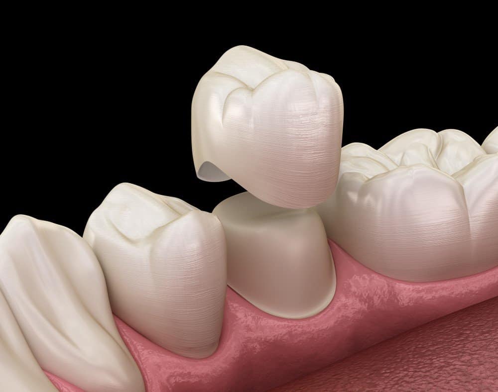 Teeth Whitening: Separating Facts from Fiction Barnsley