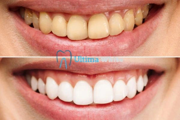 Oral Care Tips for Current and Former Smokers Barnsley