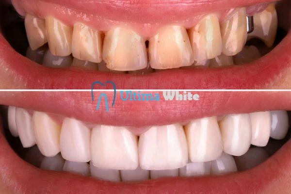 What Makes Instant Teeth Whitening Treatments So Popular Barnsley?