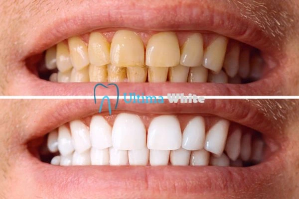 Stained Teeth and Persistent Bad Breath Barnsley