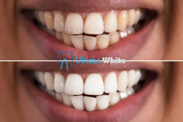 Aftercare Tips to Maintain Your New Smile Barnsley